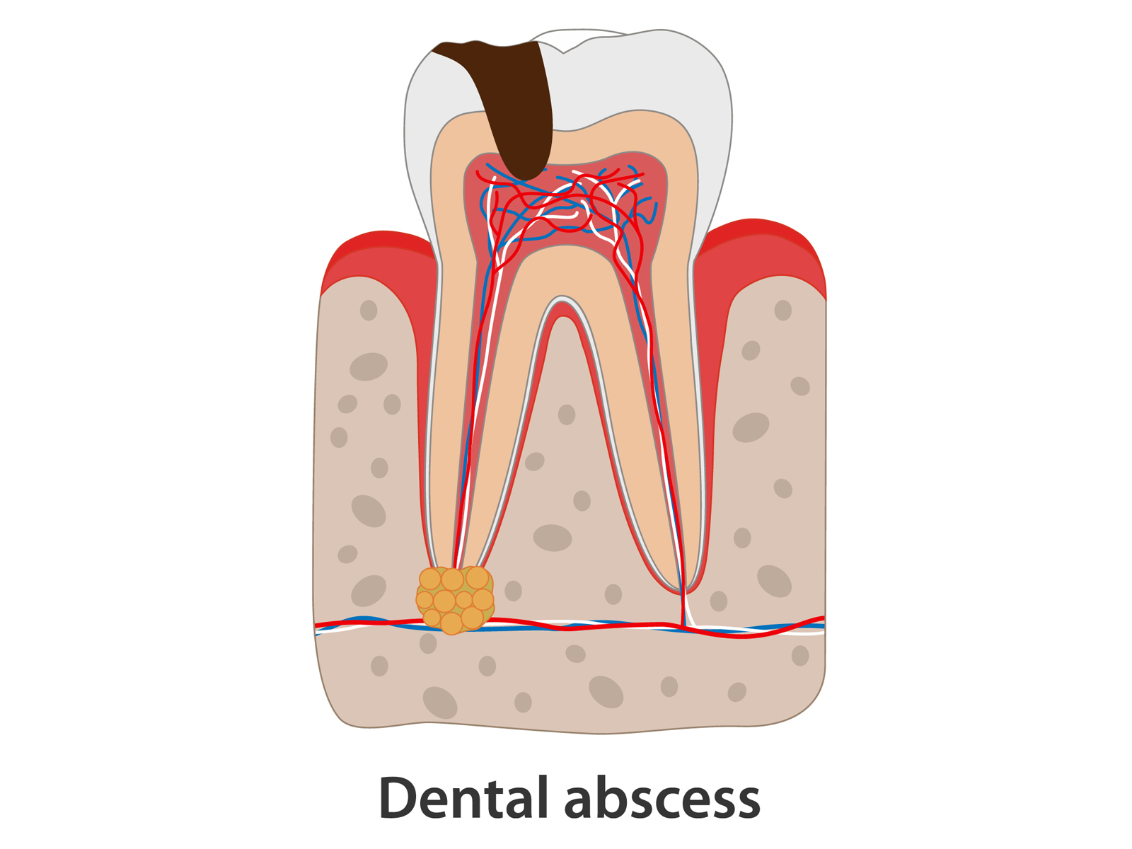 How long does it take for an abscess to drain on its own?