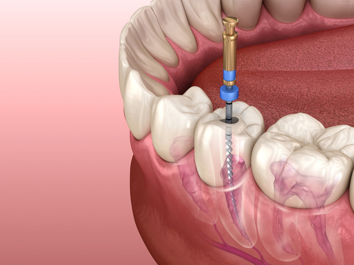 Why is root canal treatment so expensive?