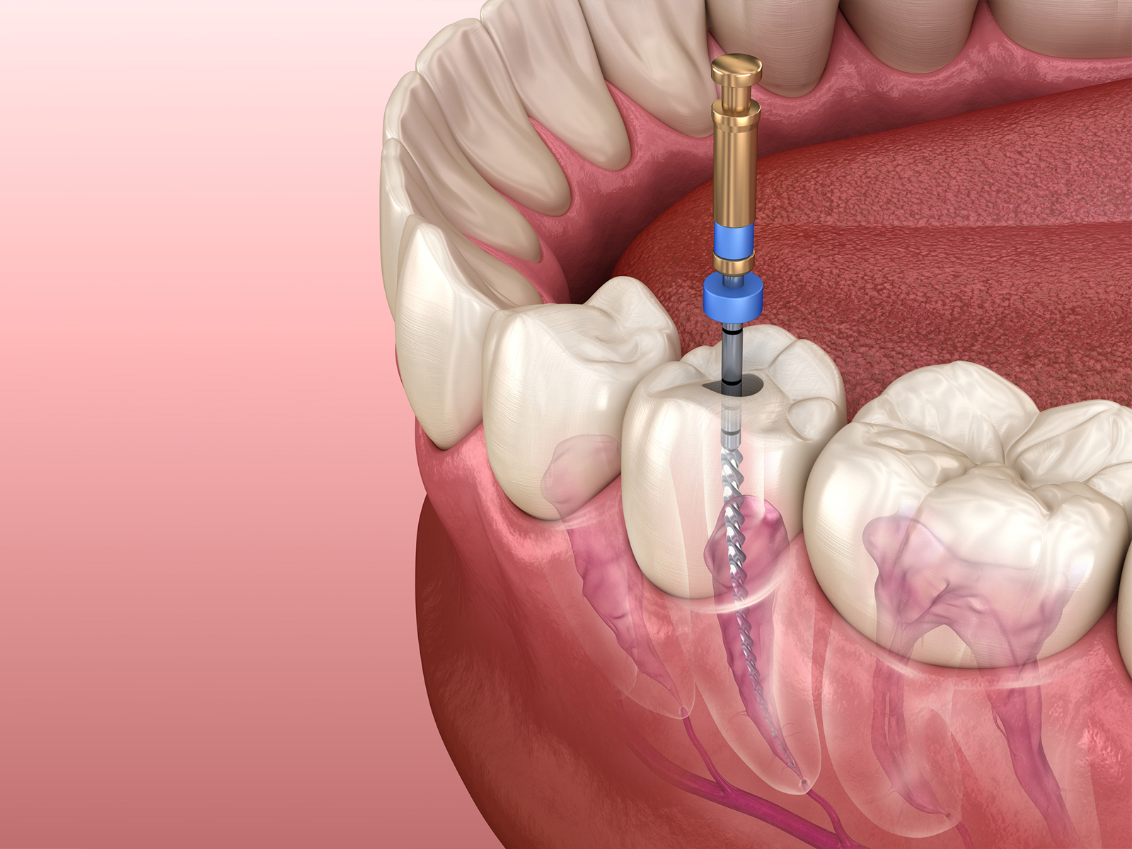 Why is root canal treatment so expensive?