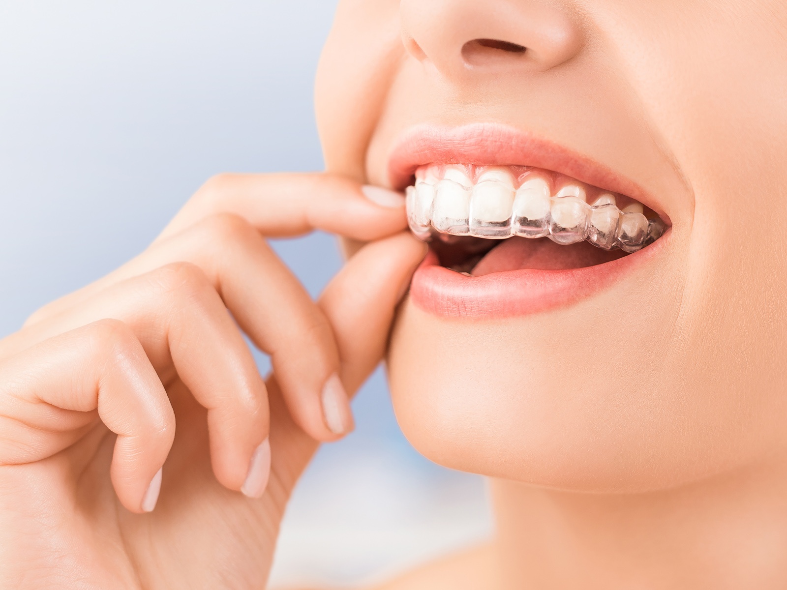 Can you whiten your teeth while having Invisalign?
