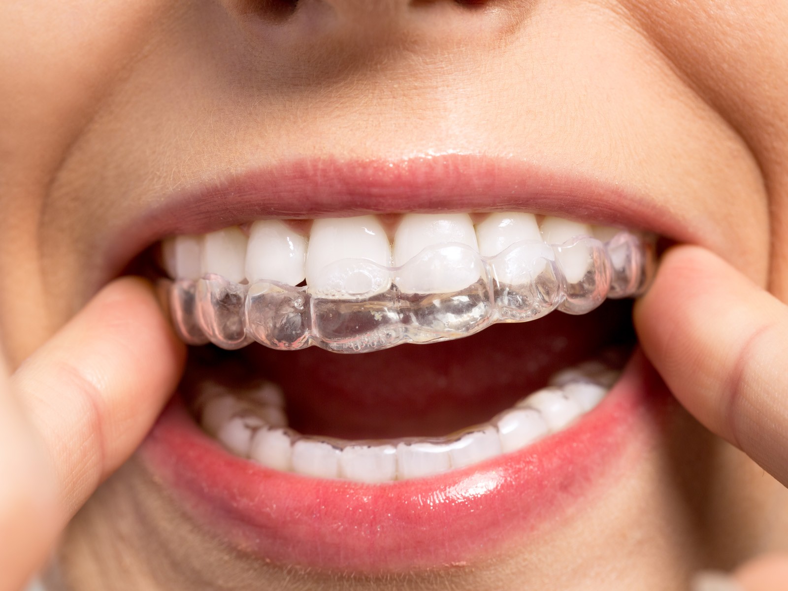 How can I remove Invisalign without pain?