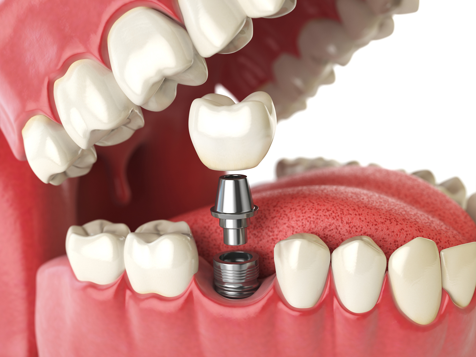 Dental Implants: What’s The Recovery Time?