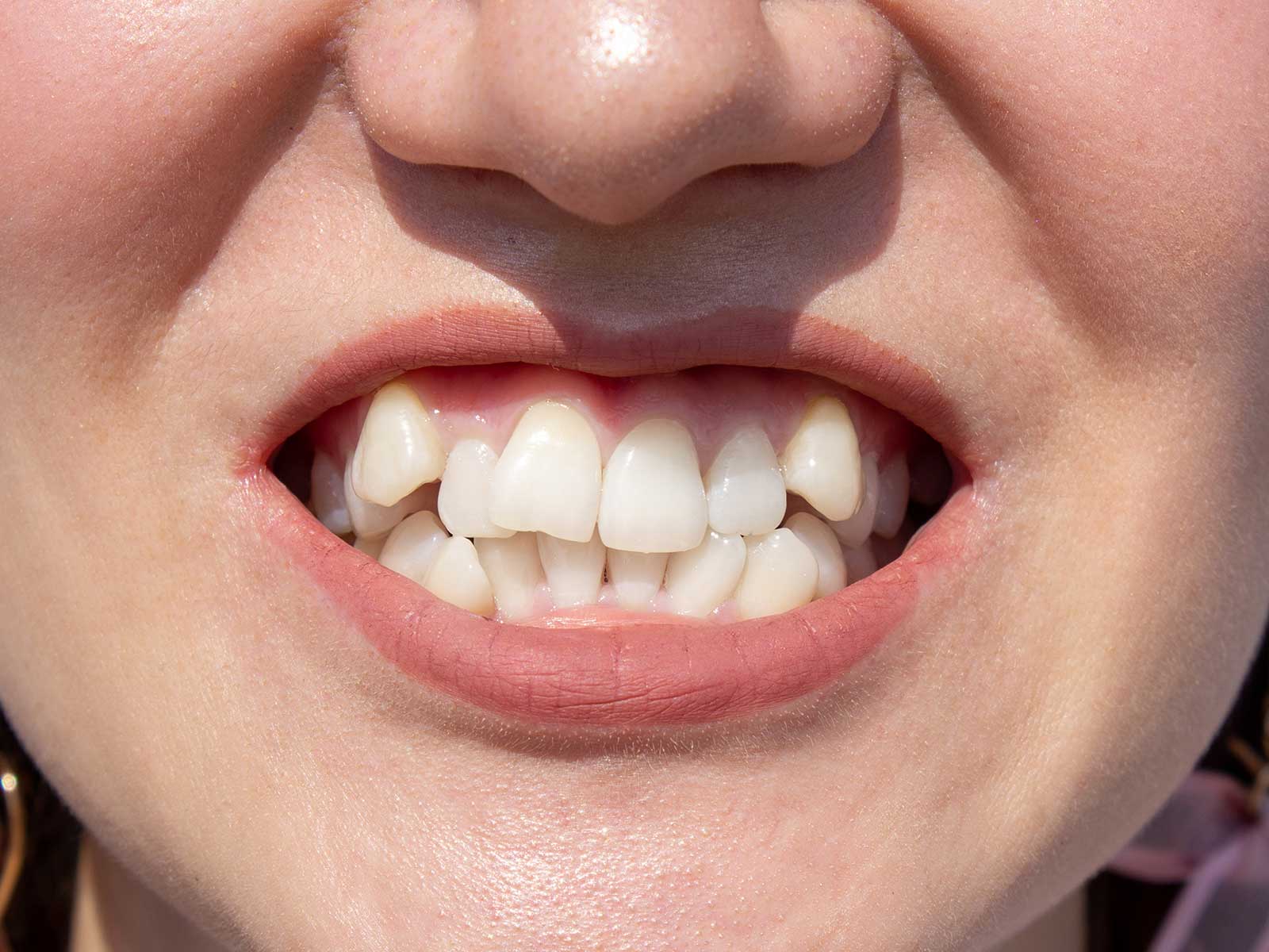 What causes overlapping of teeth?