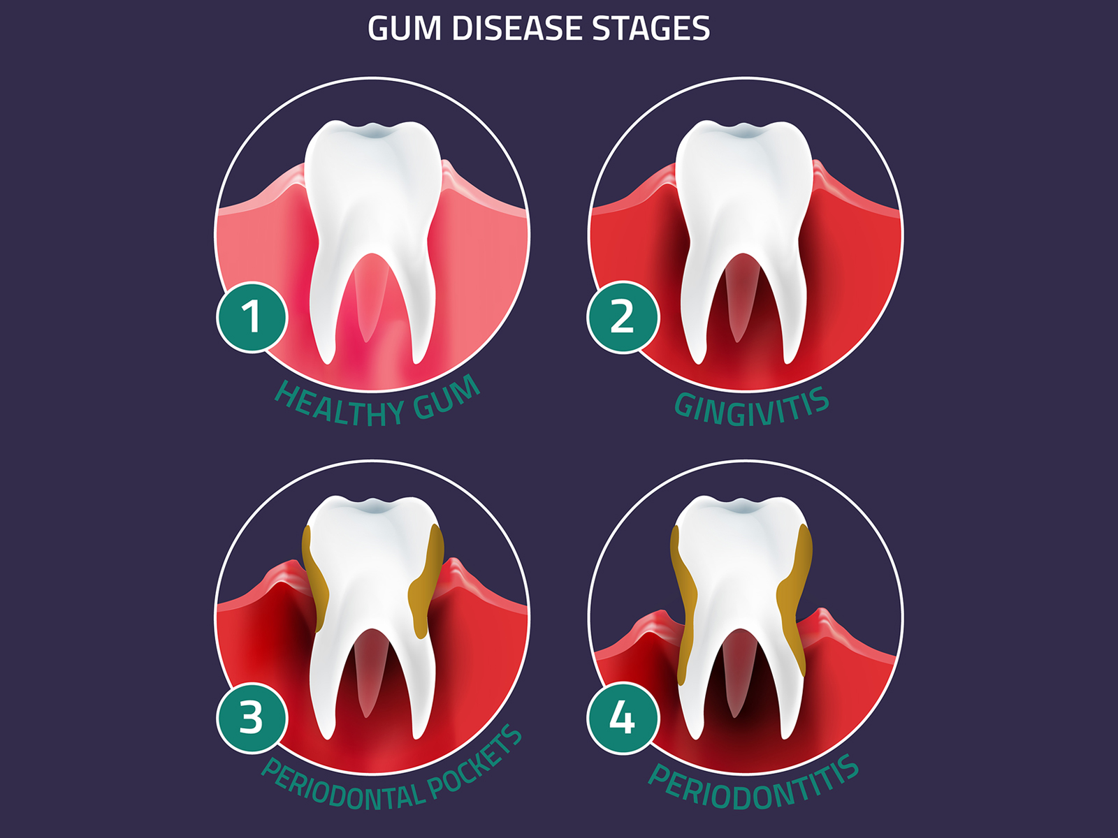 Health Conditions That Periodontal Disease Can Cause