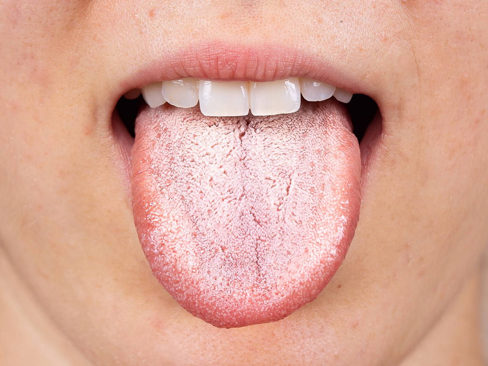 What Are Some Common Causes of Dry Mouth?