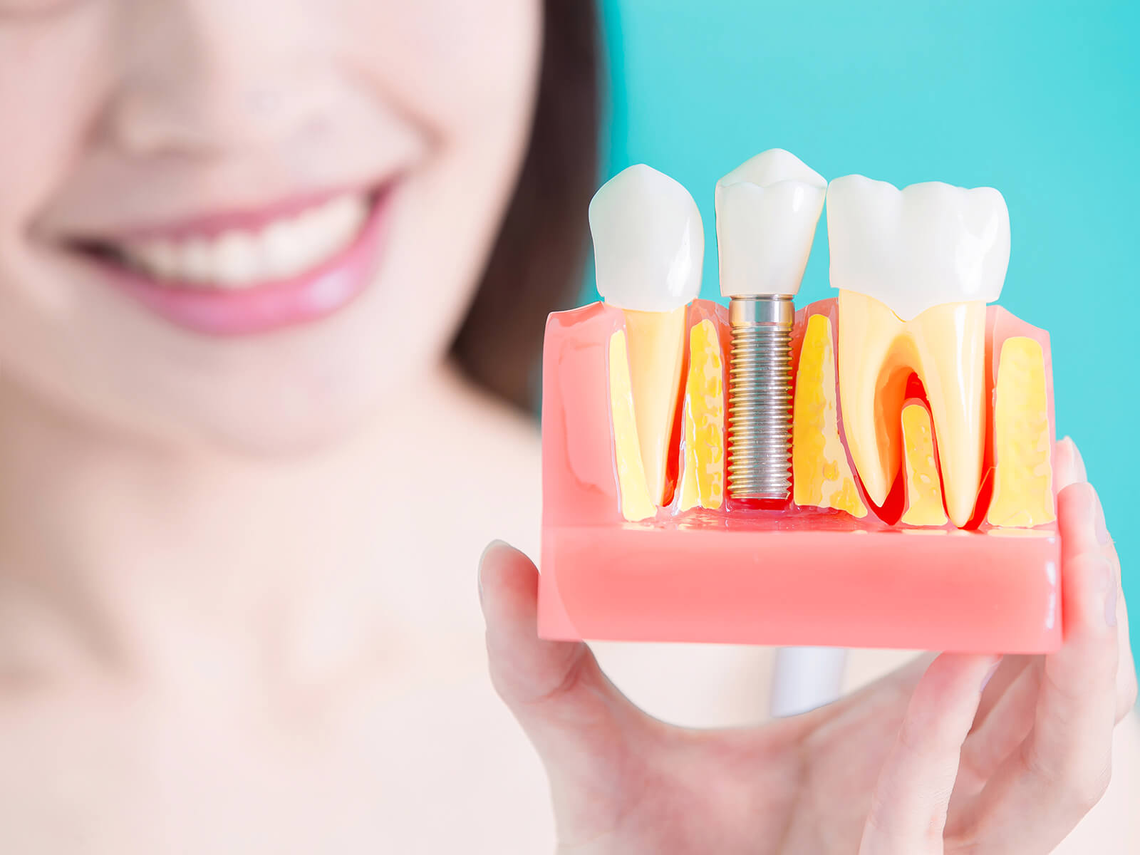 Pros and Cons of Dental Implants for Comprehensive Tooth Replacement