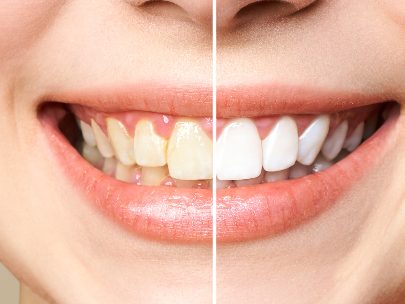 Teeth Whitening for Sensitive Teeth: Expert Tips and Recommendations