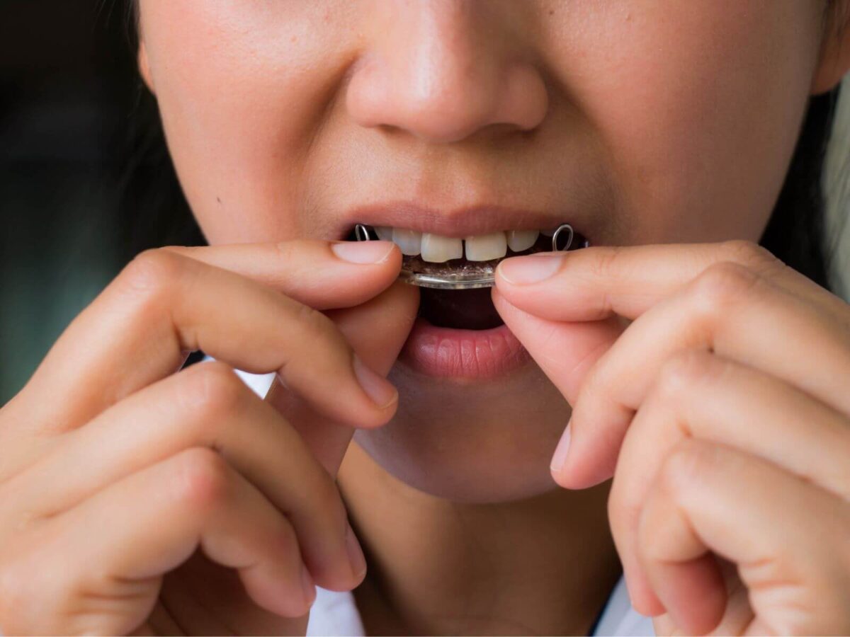 What You Need To Know About Gaps Between Teeth