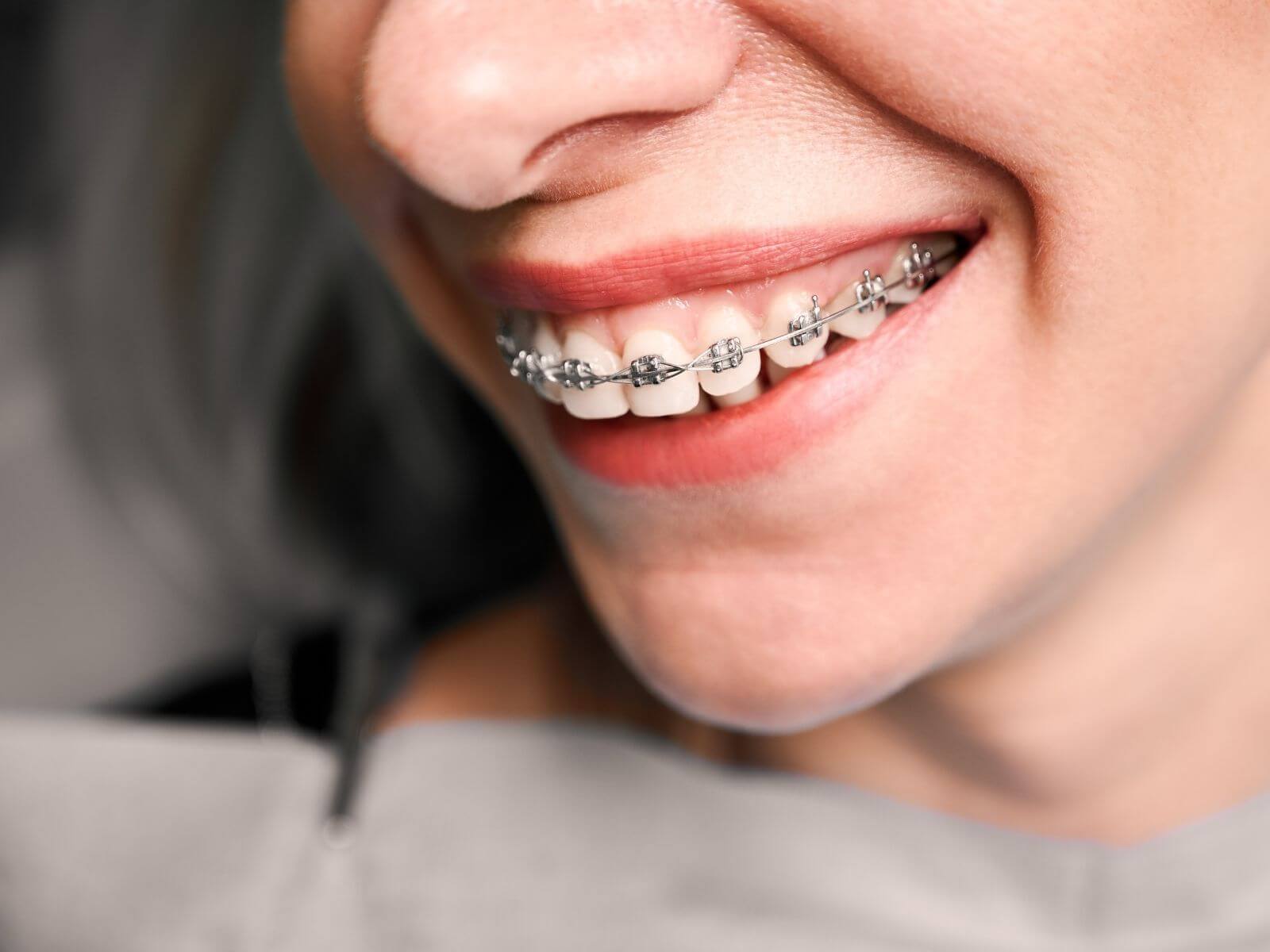 Understanding Bite Problems And How Braces Can Help