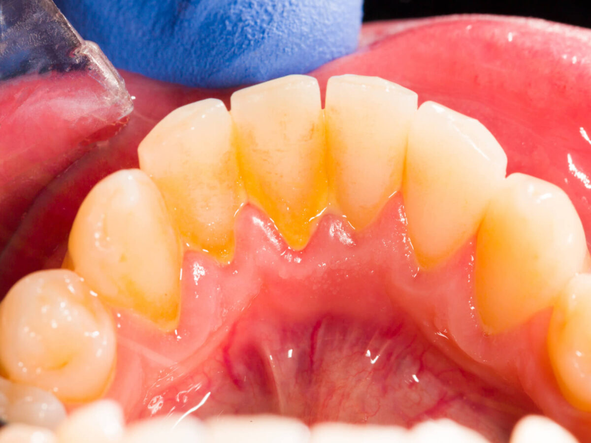 How Water Flossing Outperforms Traditional Flossing in Plaque Removal