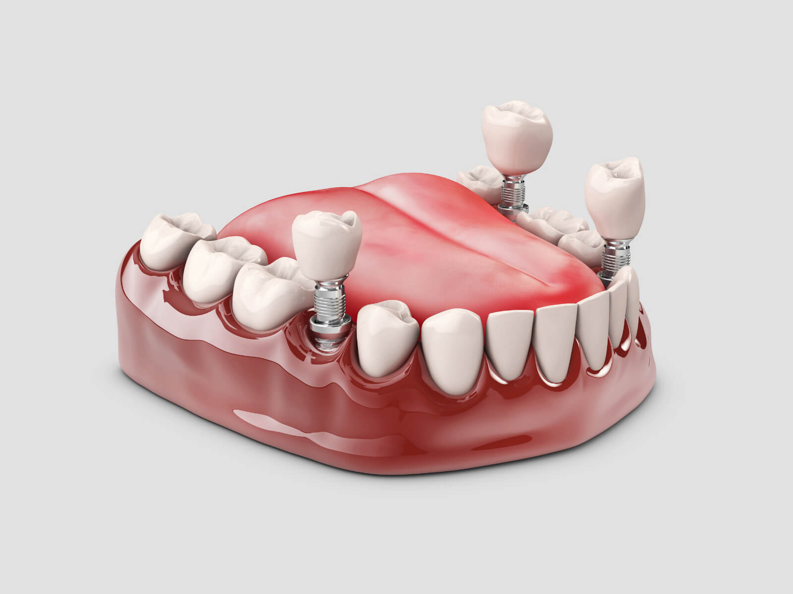 5 Steps to Increase the Longevity of Your Dental Implants