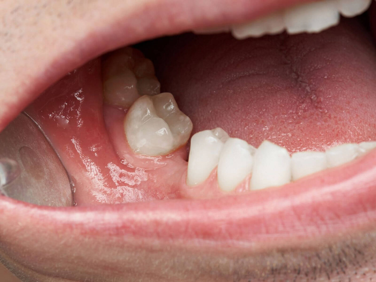 Can Missing Teeth Cause Bone Loss In The Jaw?