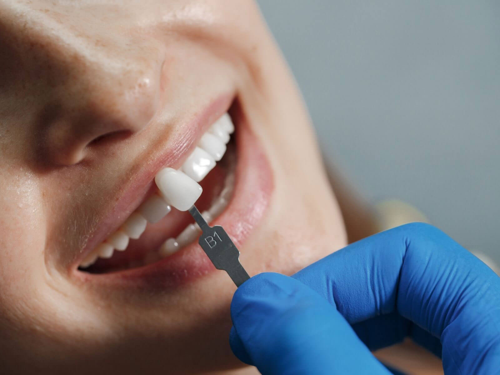 Why Do My Teeth Feel Sensitive After Getting Veneers?