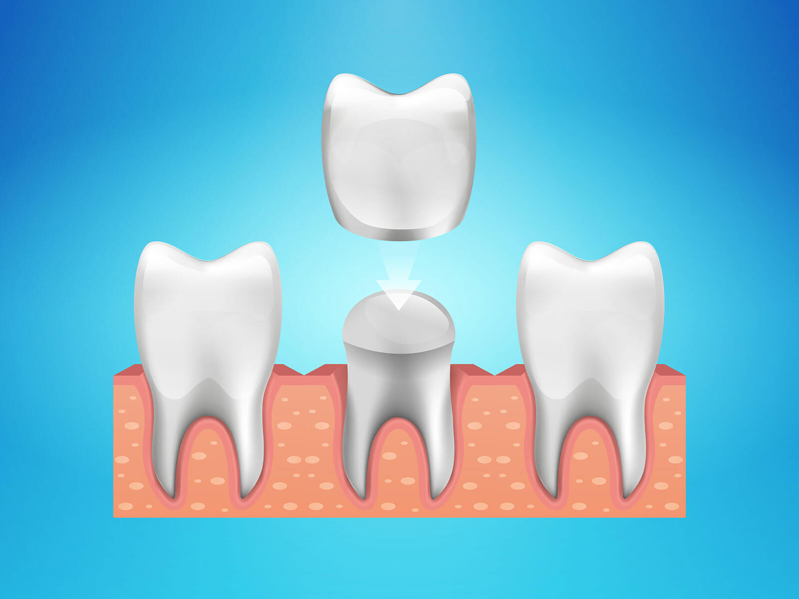 6 Signs You Need a Dental Crown