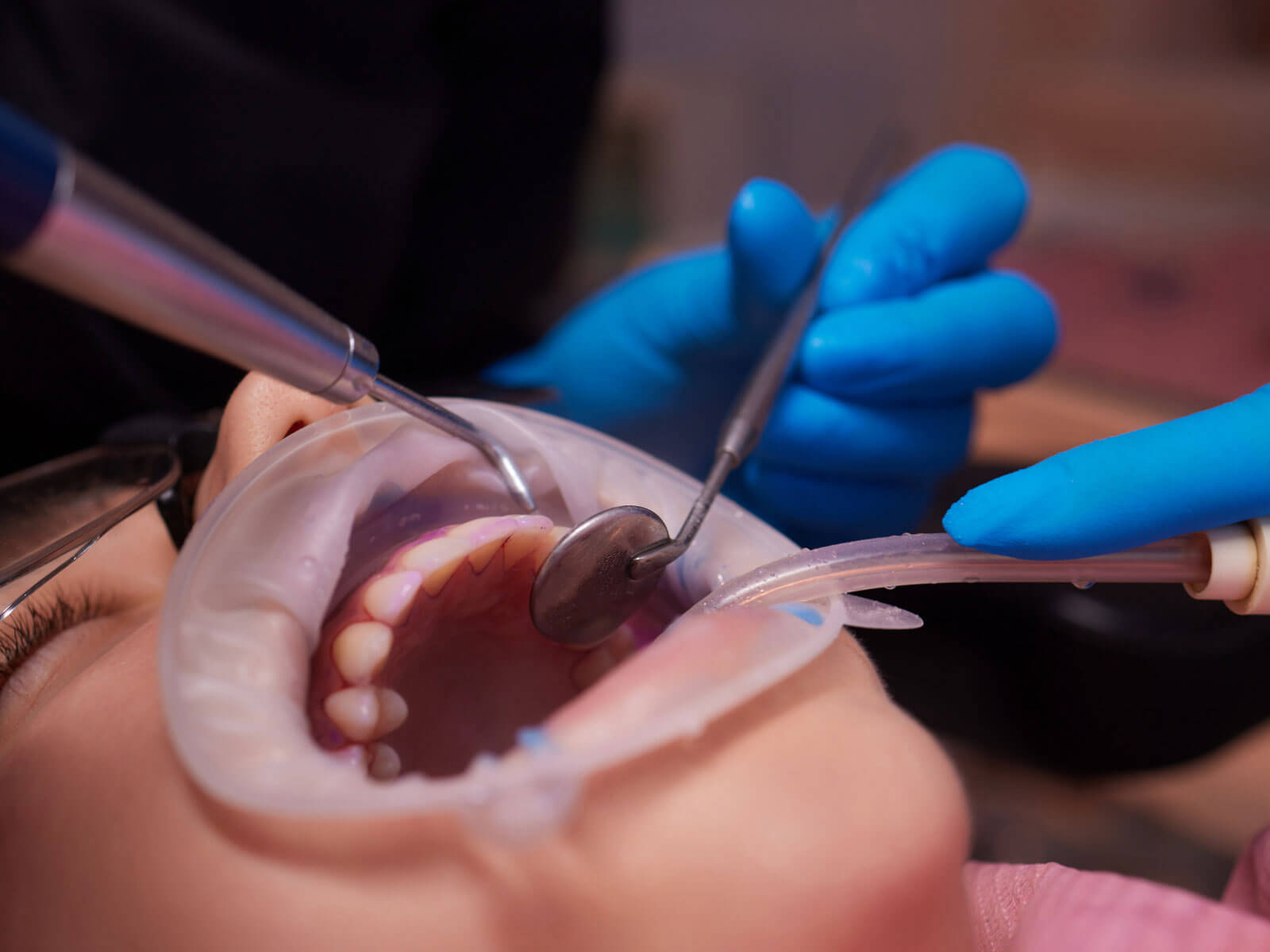 Dental Sealants Pros and Cons: Are They Worth It for Kids and Adults?