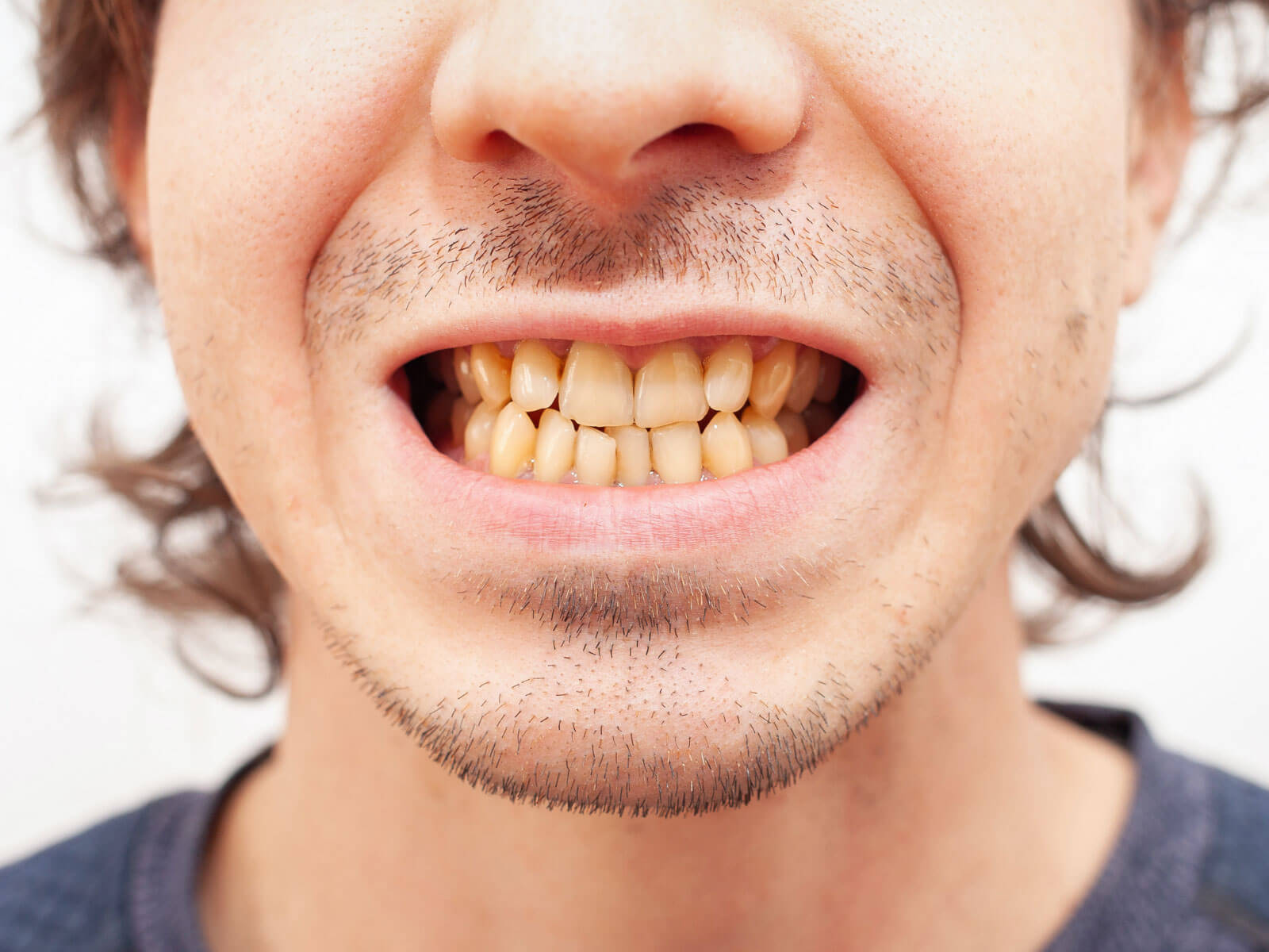 How to Get Rid of Yellow Teeth: 7 Home Remedies + Professional Whitening Options