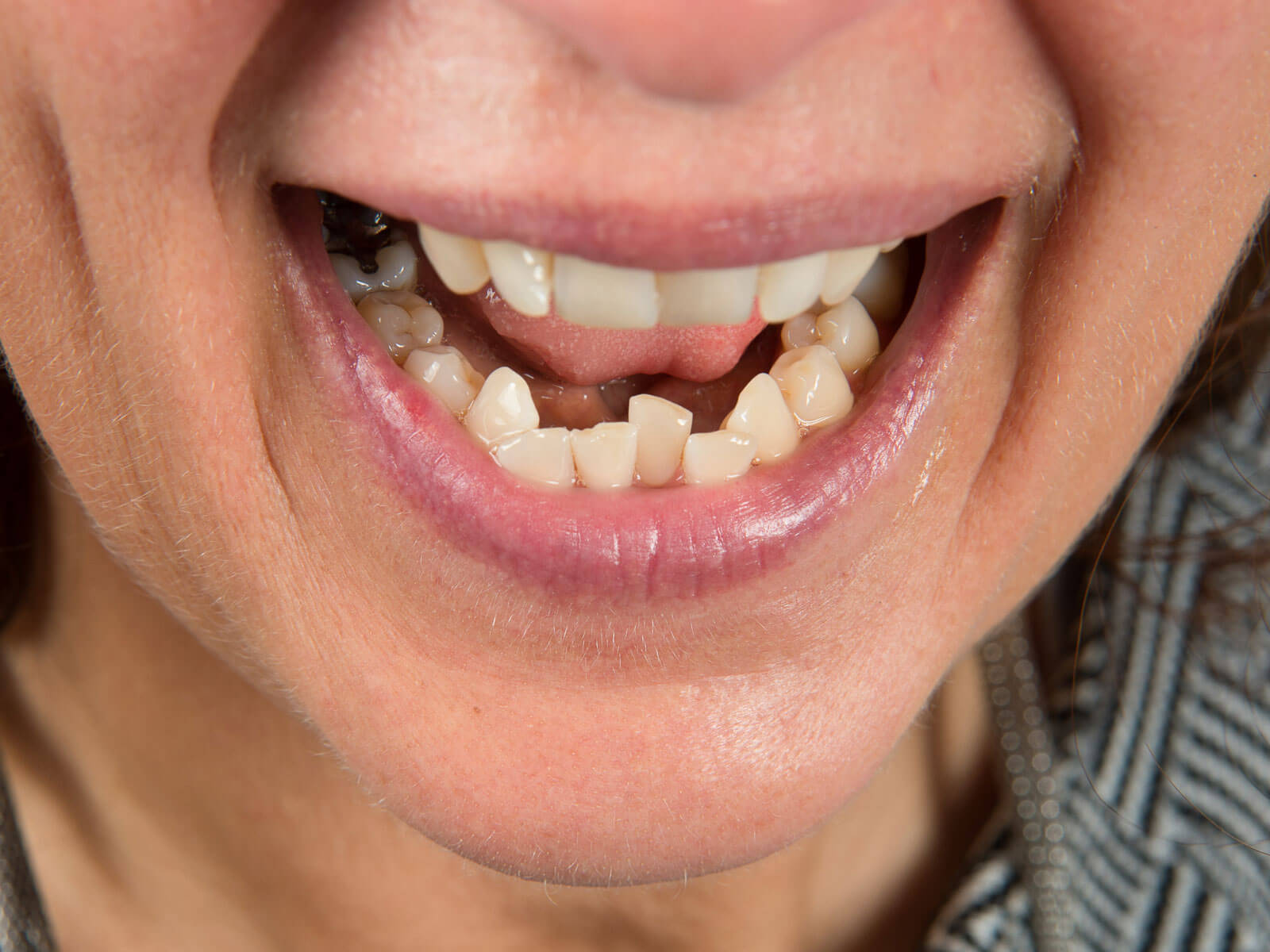 Teeth Overcrowding: Causes, Symptoms & Treatment Options