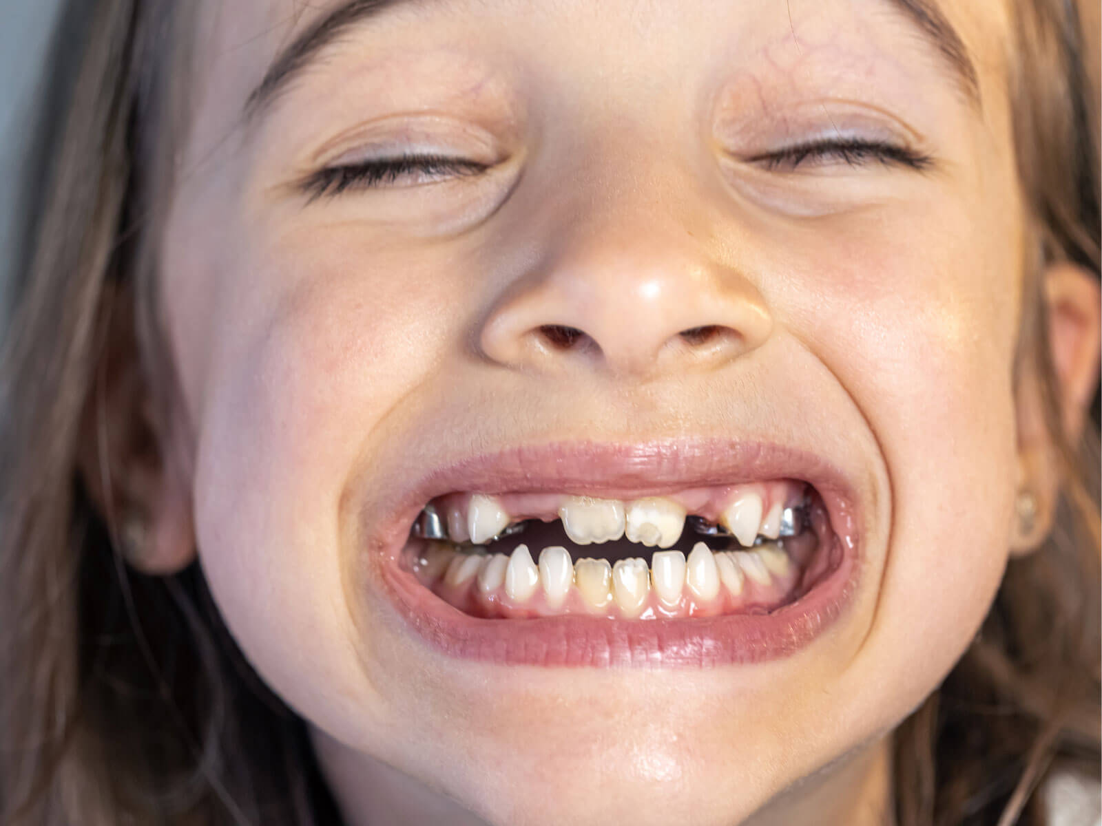 What Is an Open Bite? Causes, Symptoms & Treatment Options